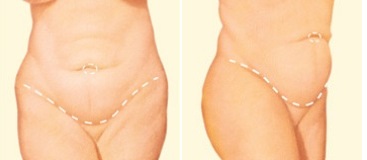 tummy tuck cyprus.jpg